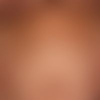 Lineare IgA-Dermatose mit symmetrischen urtikariellen Plaques und gruppierten Papulo-Vesikeln und...