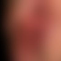 Squamous cell carcinoma of the skin: large, fast-growing, painless, flat ulcerated lump, not disp...