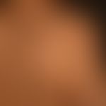 Lichen striatus: Lichen planus pigmentosus (histologically typical pattern with distinct pigment ...