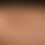 Lichen planus pigmentosus: exanthematic, pigmented Lichen planus, initially moderate itching; at ...