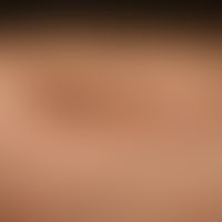 Lichen planus pigmentosus: exanthematic, pigmented Lichen planus, initially moderate itching; at ...