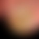 Onycholysis: idiopathic onycholysis
