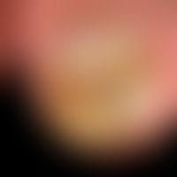 Onycholysis: idiopathic onycholysis
