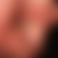 Paronychie chronische: seit Monaten bestehende&nbsp;mäßig&nbsp; schmerzhafte Paronychie.&nbsp;Nag...