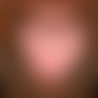 Melkersson-Rosenthal syndrome. distinct doughy swelling of the upper lip. pronounced lingua plica...