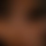 Chloasma/Melasma&nbsp;bei einer&nbsp;35 Jahre alten Patientin. Großfllächige unscharf begrenzte H...