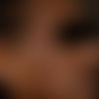 Chloasma/Melasma&nbsp;bei einer&nbsp;35 Jahre alten Patientin. Großfllächige unscharf begrenzte H...