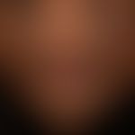 Chloasma/Melasma&nbsp;bei einer&nbsp;35 Jahre alten Patientin. Großfllächige, unscharf begrenzte,...