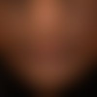 Chloasma/Melasma&nbsp;bei einer&nbsp;35 Jahre alten Patientin. Großfllächige, unscharf begrenzte,...