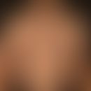 Pityriasis lichenoides chronica: 19jähriger, ansonsten gesunder&nbsp;Patient, mit einem seit 1 Ja...