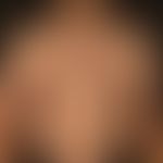 Pityriasis lichenoides chronica: 19jähriger, ansonsten gesunder&nbsp;Patient, mit einem seit 1 Ja...