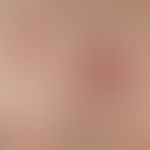 Pityriasis lichenoides chronica: 19jähriger, ansonsten gesunder&nbsp;Patient, mit einem seit 1 Ja...