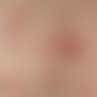 Pityriasis lichenoides chronica: 19-year-old, otherwise healthy patient with a papular exanthema ...