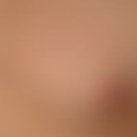 Pityriasis lichenoides chronica: 19-year-old, otherwise healthy patient with a papular exanthema ...