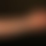 Syphilid ulzeröses: 3,0 cm großes, nicht schmerzendes, ulzeröses Syphilid. Zentrale Krustenbildun...