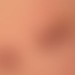 Syphilid ulzeröses: asymmetrisch verteiltes (deutlich weniger dichtes), disseminiertes,&nbsp;ulze...