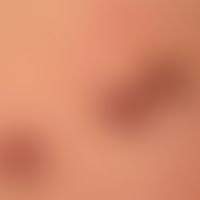 Syphilid ulzeröses: asymmetrisch verteiltes (deutlich weniger dichtes), disseminiertes,&nbsp;ulze...