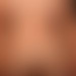 Syphilid ulzeröses: asymmetrisch verteiltes (deutlich weniger dichtes), disseminiertes,&nbsp;ulze...