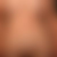 Syphilid ulzeröses: asymmetrisch verteiltes (deutlich weniger dichtes), disseminiertes,&nbsp;ulze...