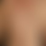 Frühsyphilis: papulöses Syphilid. Völlig asymptomatisches, symmetrisches, papulöses&nbsp;Exanthem...