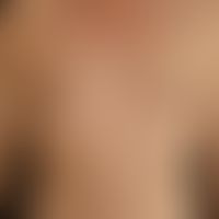 Frühsyphilis: papulöses Syphilid. Völlig asymptomatisches, symmetrisches, papulöses&nbsp;Exanthem...