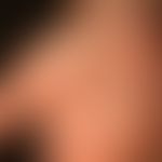 Papulöses Syphilid:&nbsp; generalisiertes papulöses Syphilid. Detailaufnahme&nbsp;der Handfläche ...