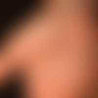 Papulöses Syphilid:&nbsp; generalisiertes papulöses Syphilid. Detailaufnahme&nbsp;der Handfläche ...