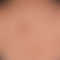 Sarcoidosis plaque form: Symptomless, 5.0 cm large, coarse lamellar scaling plaque that has exist...