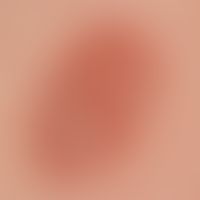 Sarcoidosis plaque form: 5.0 cm large, coarse lamellar scaling, reddish-brown plaque, existing fo...