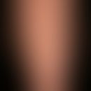 Stucco keratosis:disseminated, up to 0.4 cm large, white-grey, symptomless, warty papules; modera...