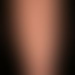 Stucco keratosis:disseminated, up to 0.4 cm large, white-grey, symptomless, warty papules; modera...
