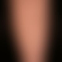 Stukkokeratosis: disseminierte, bis 0,4 cm große, weiß-graue, symptomlose, warzige&nbsp;Papeln.&n...