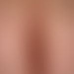 Acne inversa. Schwerer klinischer, therapieresistenter&nbsp;Befund bei einer 52 Jahre alten Patie...