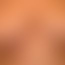 Acne inversa. severe clinical, therapy-resistant findings in a 52-year-old female patient. existi...