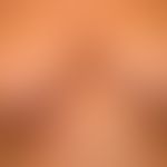 Acne inversa. Schwerer klinischer, therapieresistenter&nbsp;Befund bei einer 52 Jahre alten Patie...