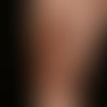 Necrobiosis lipoidica: a condition that has existed for years and is constantly worsening; no dia...