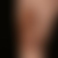 Necrobiosis lipoidica: seit Jahren bestehender und permanent sich vergrößernder Befund. Kein Diab...