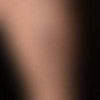 Necrobiosis lipoidica: existing for about 1 year; no diabetes mellitus known.
