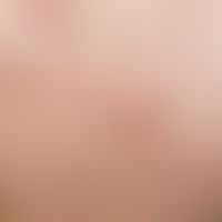 Pityriasis lichenoides et varioliformis acuta. after febrile infection acutely occurring, "colorf...