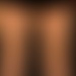 Lymphomatoid papulosis: chronic, relapsing, completely asymptomatic clinical picture with multipl...