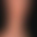 Dermatoliposklerose. 64-jähriger Patientin &nbsp;mit bekannter CVI. Seit Jahren zunehmende Verhär...