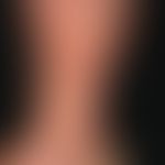 Dermatoliposclerosis. 64-year-old female patient with known CVI. For years increasing hardening o...