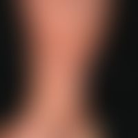Dermatoliposclerosis. 64-year-old female patient with known CVI. For years increasing hardening o...