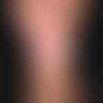 Dermatoliposclerosis. 64-year-old female patient with known CVI. For years increasing hardening o...