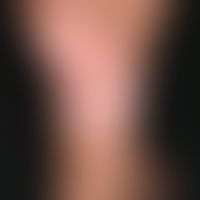 Dermatoliposclerosis. 64-year-old female patient with known CVI. For years increasing hardening o...