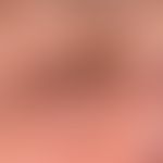 Fibroma molle: harmloser, seit vielen Jahren bekannter und unveränderter, symptomloser&nbsp;"Tumo...