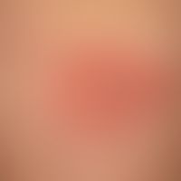 Superinfizierter Insektenstich mit beginnendem Erysipel und Lymphangitis.
