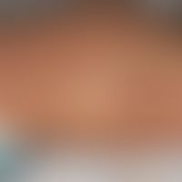 Incontinentia pigmenti, Typ Bloch-Sulzberger: wenige Wochen altes Mädchen mit flächigen und strei...
