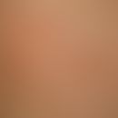 Incontinentia pigmenti, type Bloch-Sulzberger (back part): a few weeks old girl with grouped blis...