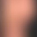 Keratoderma blennorrhagicum: Zirzinäre hyperkeratotische, teils pustulöse bzw. erosive Herde.&nbs...